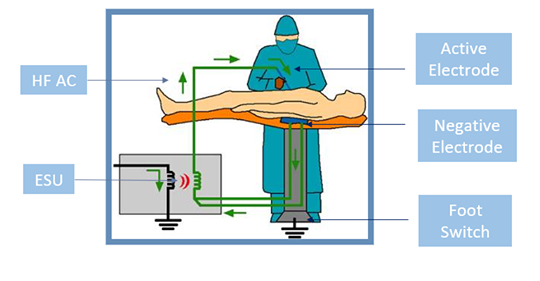 High-frequency electrosurgical units have been widely applied in surgical operations, but incidents of electrocautery burns occasionally occur