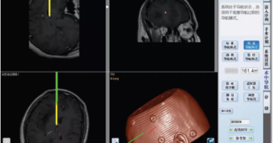 The term neuronavigation is derived from navigation, which refers to relying on a real-time positioning system to select a simple and safe route to accurate approach during navigation